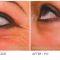 Botulinum toxin - Wrinkle Removal