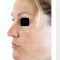 Rhinoplasty (Nose Job)