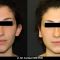 Operazione orecchie (Otoplastica)