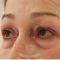 Eyelid surgery (Blepharoplasty)