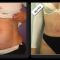 Abdominoplastie