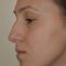 Rhinoplasty (Nose Job)
