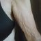 Traitement de la cellulite