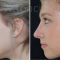 Rhinoplasty (Nose Job)