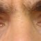 Eyelid surgery (Blepharoplasty)