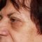Operácia očných viečok (Blepharoplastika)