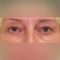 Eyelid surgery (Blepharoplasty)