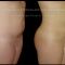 Lipoescultura láser - Smart Lipo