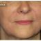 Injections de comblement