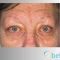 Facelift, SMAS facelifting