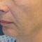 Facelift