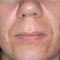 Restylane®