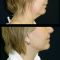 Liposuction