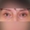 Eyelid surgery (Blepharoplasty)