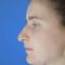 Rhinoplastie