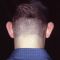 Ear surgery (Otoplasty)