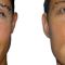Operácia nosa (Rhinoplastika)