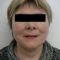 Facelift, SMAS Facelift