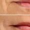 Filler antirughe a base di acido ialuronico