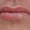 Restylane®