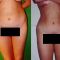 Eliminación no invasiva de grasa y celulitis – Lipoescultura