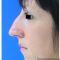 Génioplastie - Chirurgie esthétique du menton