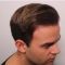 Haartransplantation