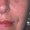 Facelift, SMAS facelifting