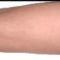 Léčba křečových žil (varixů)