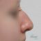 Operácia nosa (Rhinoplastika)
