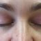 Neinvazivní blefaroplastika