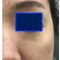 Lipofilling (grasso)