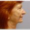 Facelift (operace obličeje), SMAS lifting