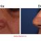 Mole removal