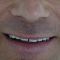 Lip Lift