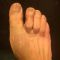 Hallux valgus -Operation
