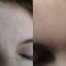 Fotoringiovanimento - resurfacing