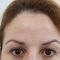 Hyperhidrose traitement (transpiration excessive) - Botox