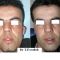 Otoplastie (Chirurgie esthétique des oreilles)