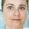 Operácia očných viečok (Blepharoplastika)
