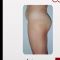 Eliminación no invasiva de grasa y celulitis – Lipoescultura