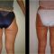 Liposuccion