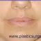 Restylane®