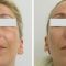 Plastika nosu (Rhinoplastika)