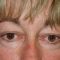 Eyelid surgery (Blepharoplasty)
