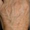 Procedure laser in dermatologia estetica