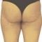 Liposuction
