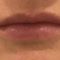 Lippenvergrößerung mit Hyaluronsäure