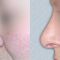 Operácia nosa (Rhinoplastika)