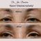 Operácia očných viečok (Blepharoplastika)